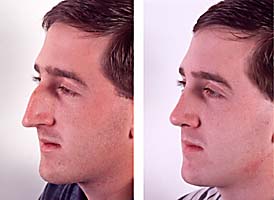 Plastic surgery (cosmetic surgery) before and after photograph