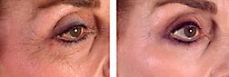 Plastic surgery (cosmetic surgery) before and after photograph