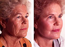 Plastic surgery (cosmetic surgery) before and after photograph